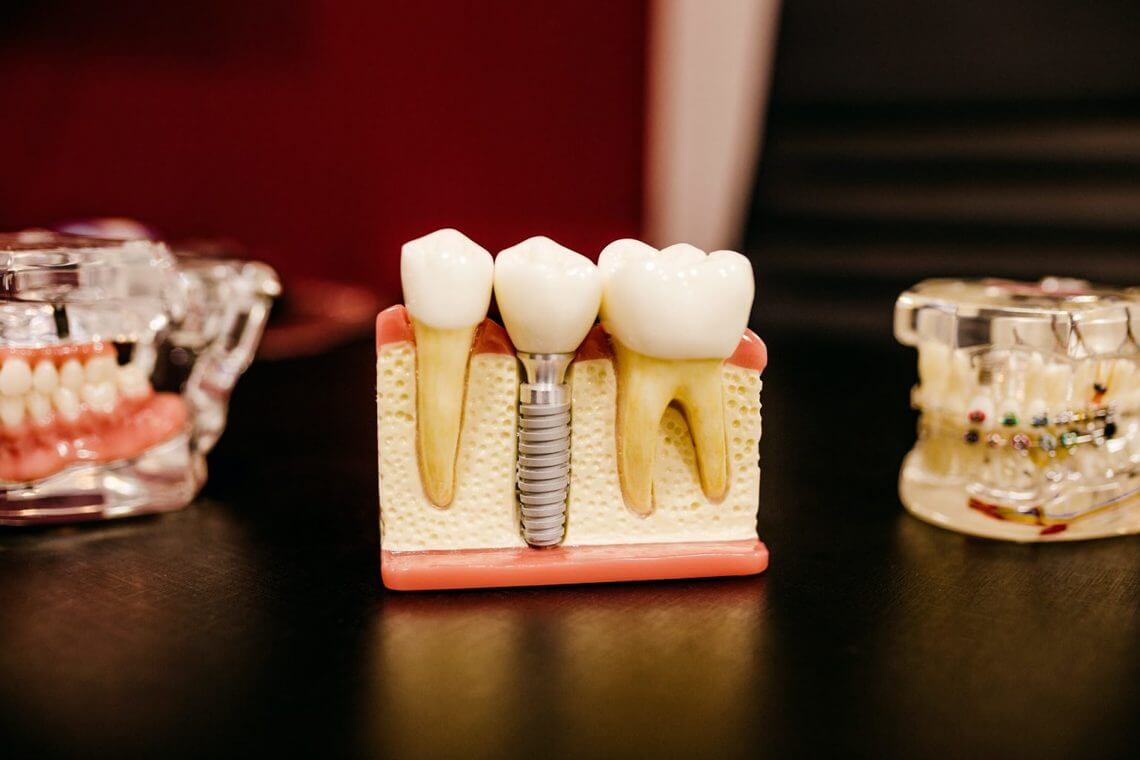 5 Reasons To Consider Dental Implants?