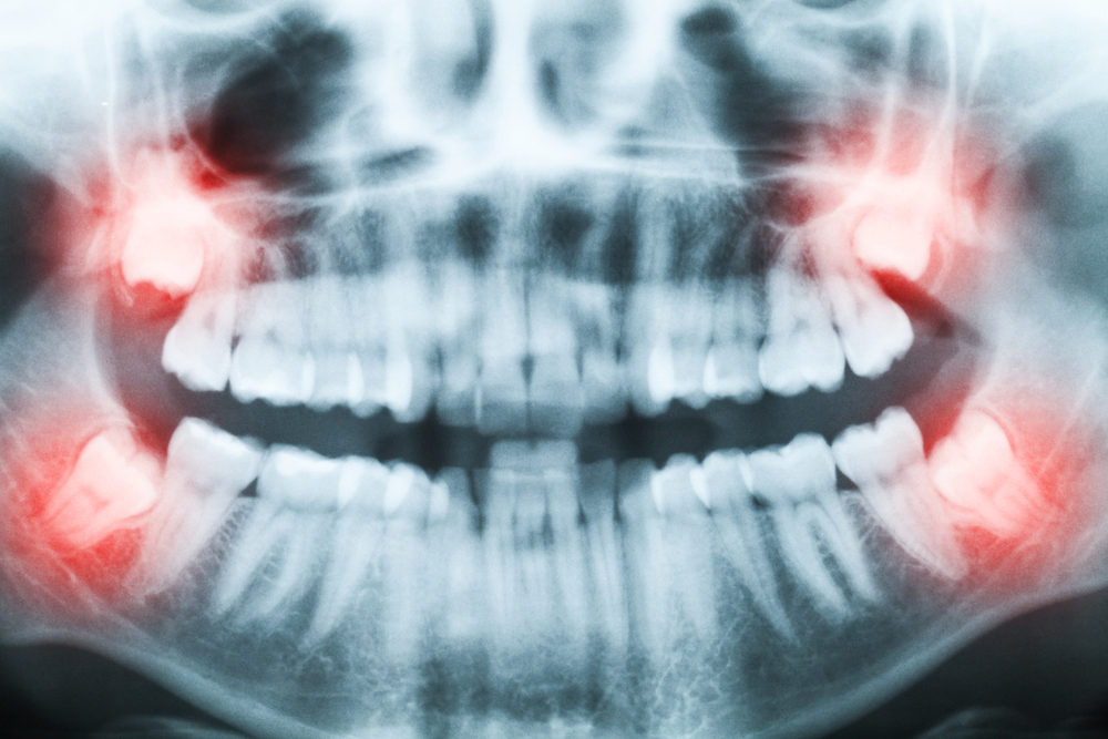 Impacted Wisdom Teeth: Signs, Symptoms, and Removal