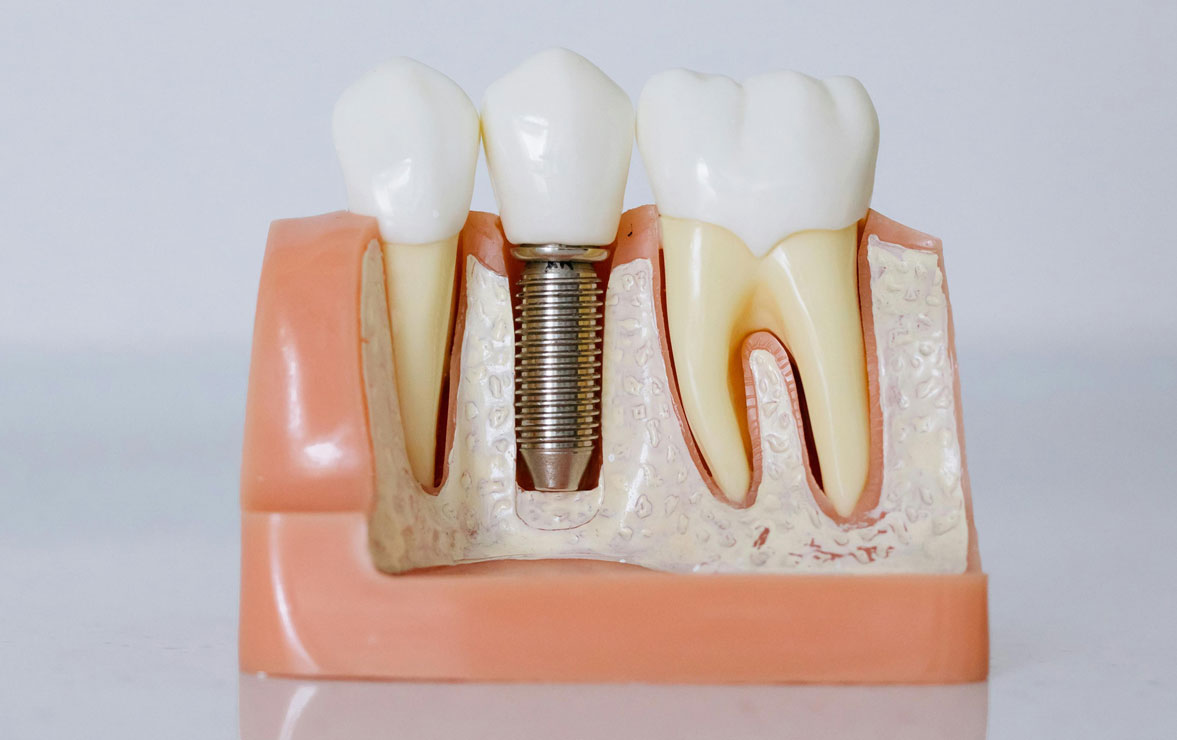 Combating Tooth Loss With Dental Implants