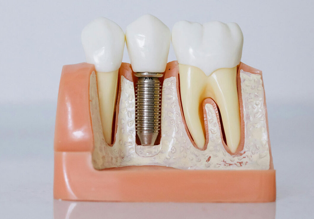 combatting-tooth-loss-with-dental-implants