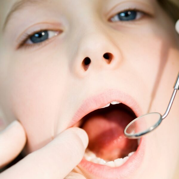 Child's dental check-up with mirror tool.