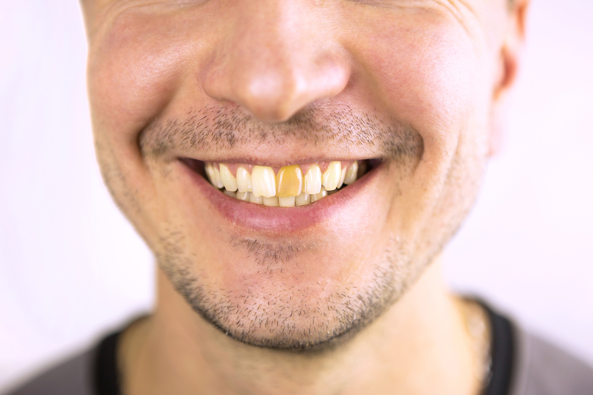 Man smiling with uneven teeth